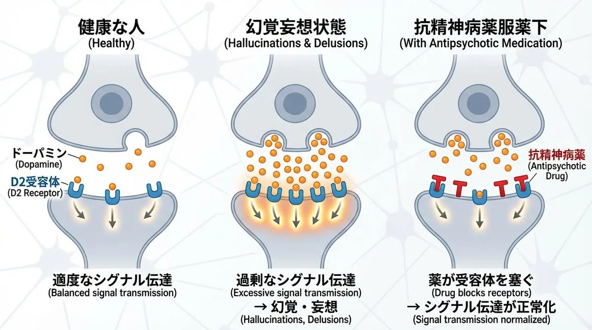 精神分裂症神经突触与多巴胺示意图